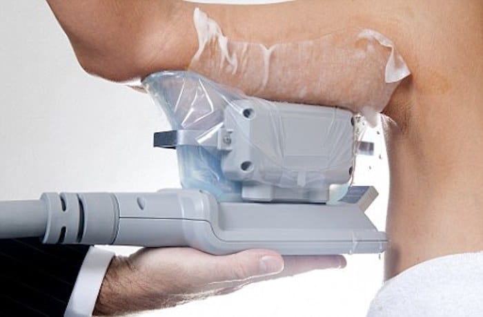 fat freezing arms Cheshunt