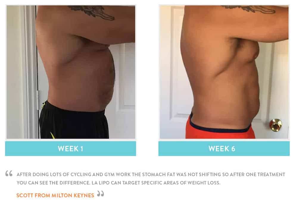 Before & After Stomach Fat Cheshunt