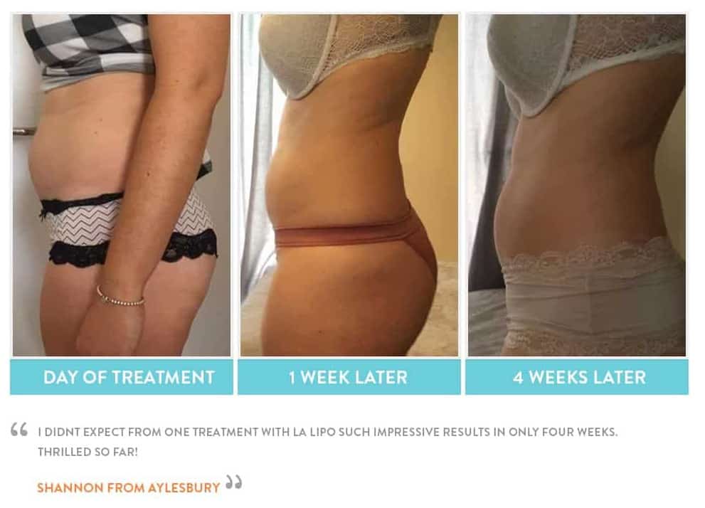 before, Cryolipolysis Cheshunt