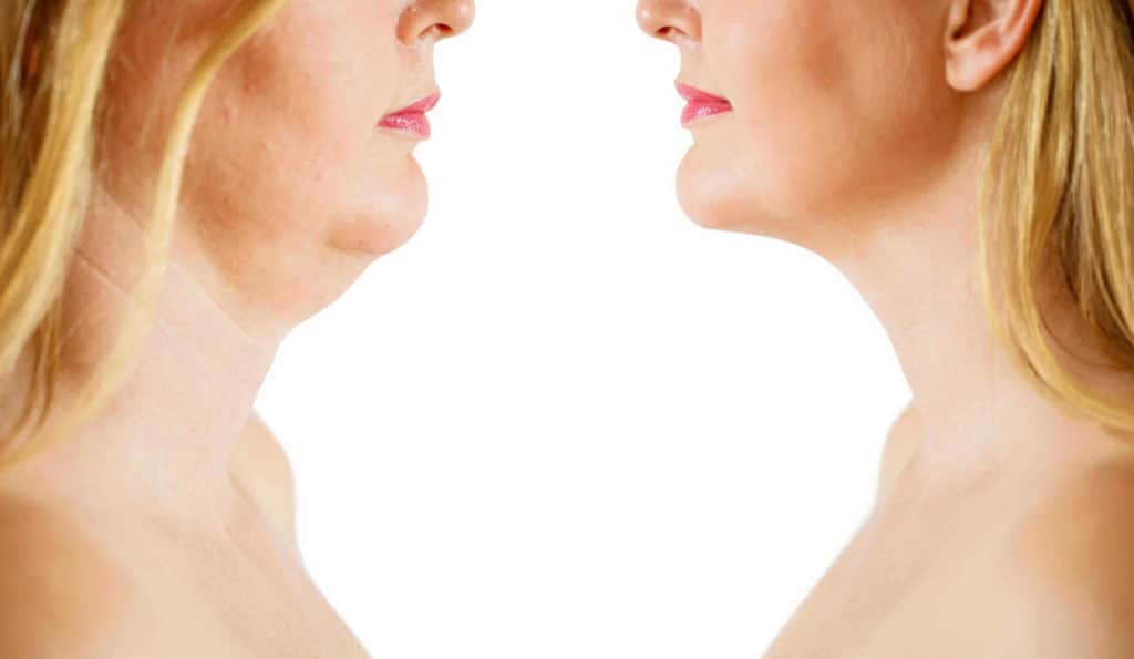 Double Chin treatment Cheshunt before and after results