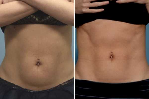 body sculpting FAQs Cheshunt