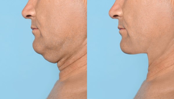 Which Non-Surgical Treatments Work Best for Jowls and Loose Skin Cheshunt?