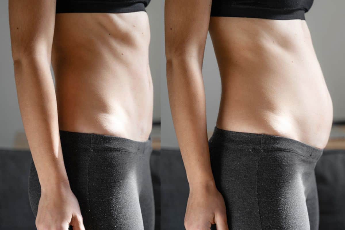 How long does diastasis recti take to improve Cheshunt?