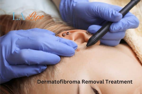 Dermatofibroma Removal Treatment Cheshunt