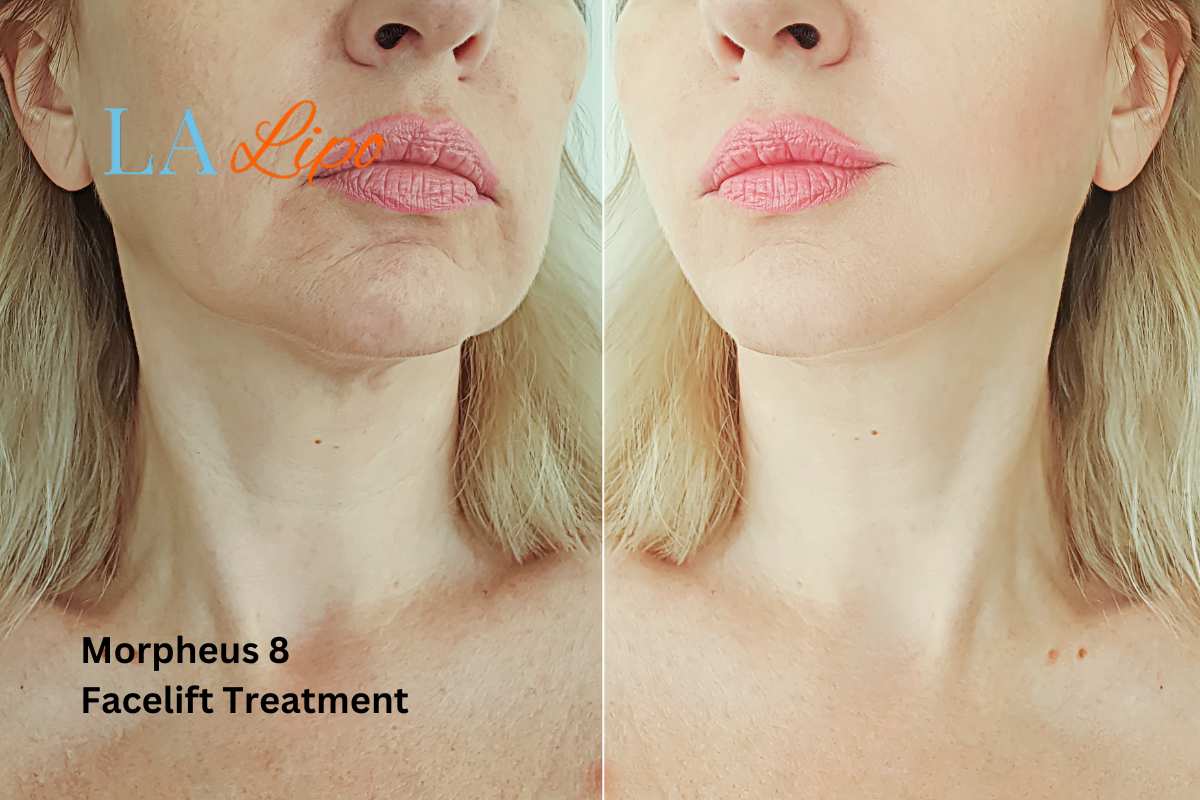 Turn back time with Morpheus8 Treatment Cheshunt
