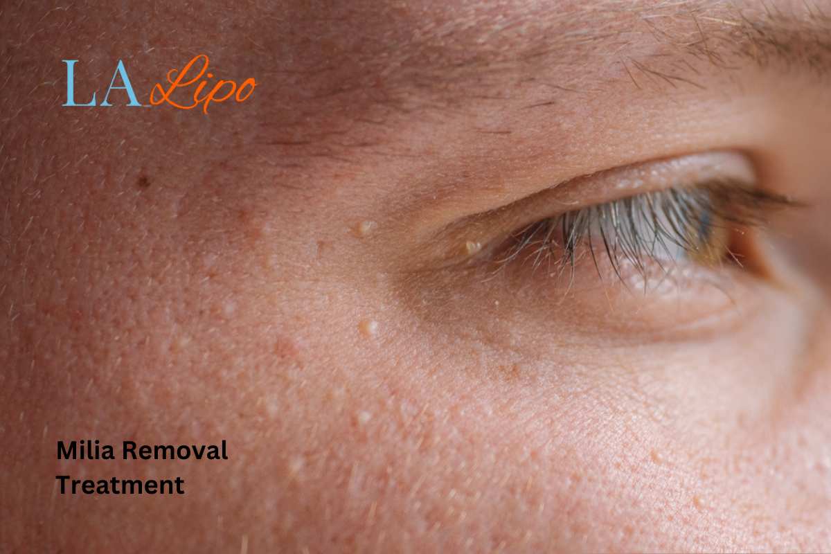 Cryopen Milia Removal: Is It the Easiest and Safest Option Cheshunt?