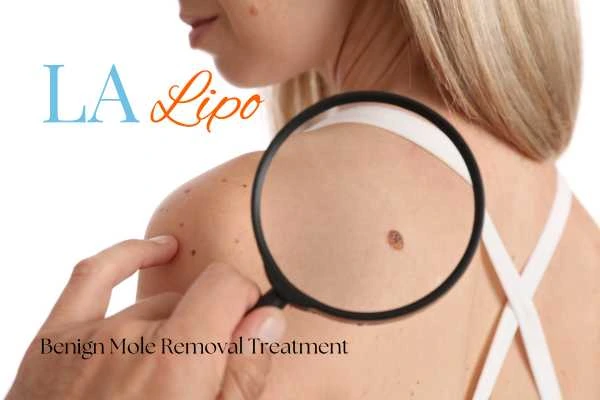 Why getting moles removed Cheshunt can boost your confidence!