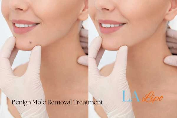 Woman's before and after results of being moles removal treatment Cheshunt
