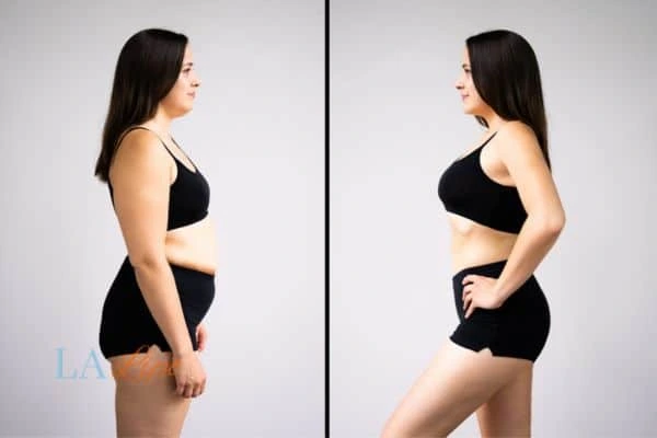 LA-EMS Body Sculpting Cheshunt results before and after of womans results on body toning.