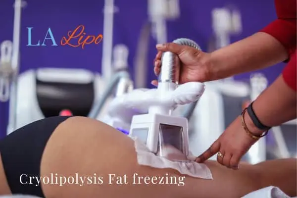 women getting fat freezing Cheshunt