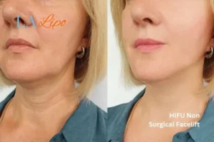 hi-fu for wrinkles Cheshunt before and after results