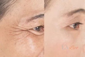 Before and after results of woman - HI-fu wrinkles reduction treatment Cheshunt