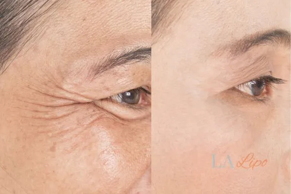 Before and after results of woman - HI-fu wrinkles reduction treatment Cheshunt