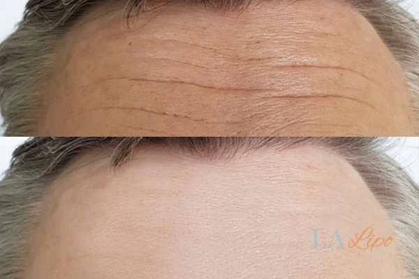 results of HIFU Cheshunt on mans forehead to help reduce lines and wrinkles