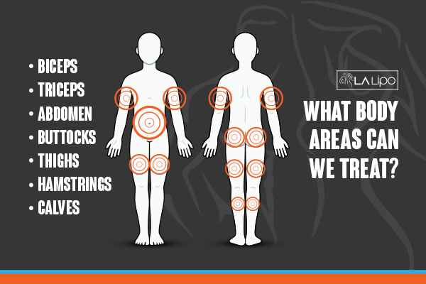 Graphic to show areas you can have LA-EMS Body Sculpting Cheshunt treatment.