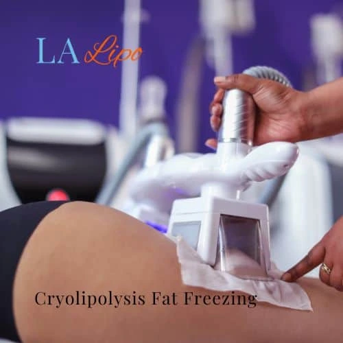 fat freezing - Cryolipolysis Cheshunt