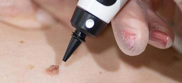 skin tag removal using cryopen Cheshunt