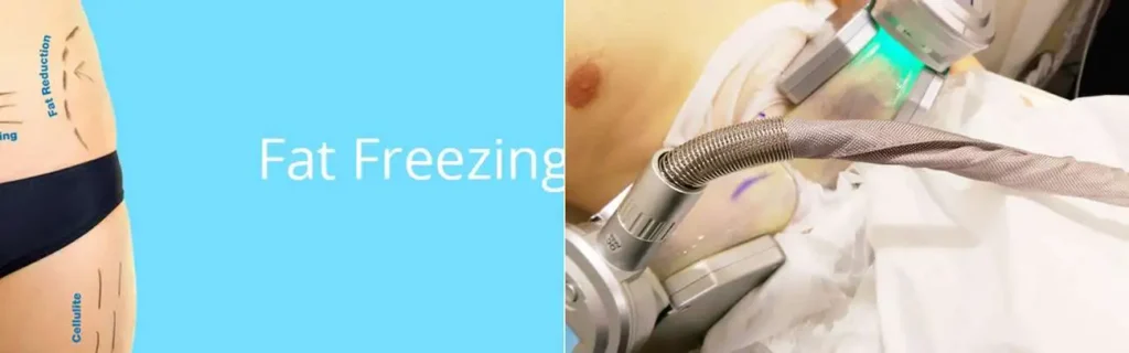 Fat freezing Cheshunt on multiple areas of the body
