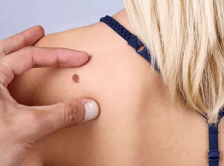 woman having mole removal Cheshunt consultation before treatment.