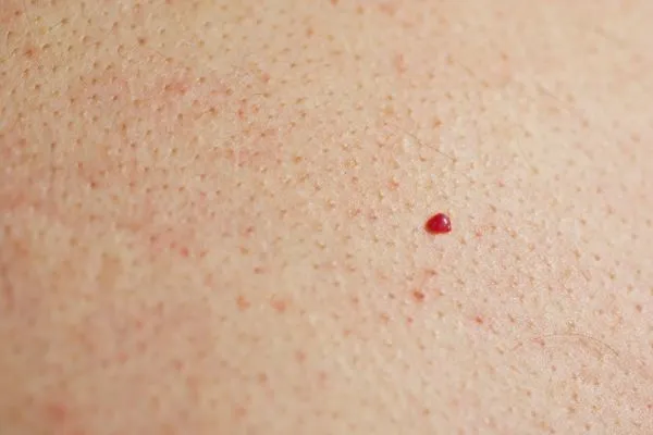 close up of a cherry angioma Cheshunt