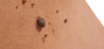 image of a skin tag Cheshunt