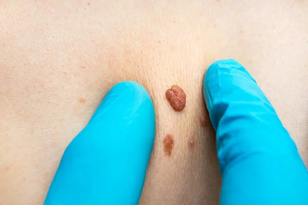 Consultant examining a skin tag Cheshunt