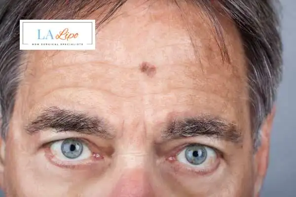 Solar Lentigo Removal Cheshunt image of man with mark on his forehead