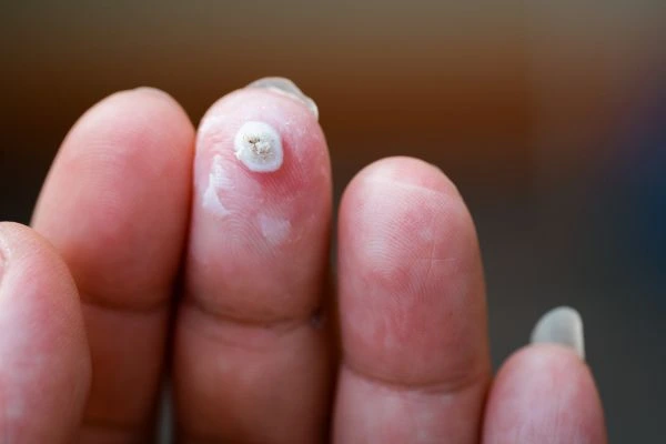 wart on person finger - cryotherapy to treat from LA LIPO Cheshunt