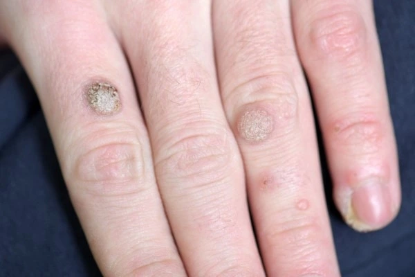 photo of warts on person hand - see wart removal Cheshunt from LA LIPO