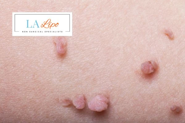 Does cryopen skin tag removal Cheshunt hurt? Find out now call our team today!