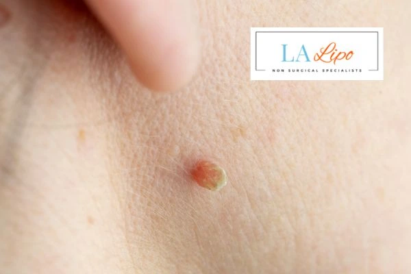 Book skin tag removal Cheshunt today speak to our team now!