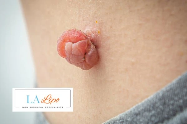 Interested in skin tag removal Cheshunt? Concerned about the pain? Find out more today!