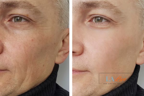 See the amazing results of Morpheus8 Treatment Cheshunt!