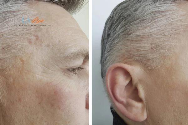 Mens Before & After Morpheus 8 Results Cheshunt