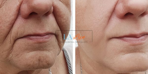 Older lady deeper wrinkle reduction - LA LIPO Morpheus 8 Results Cheshunt