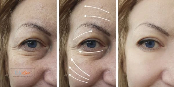 Amazing eye lift Morpheus 8 results Cheshunt