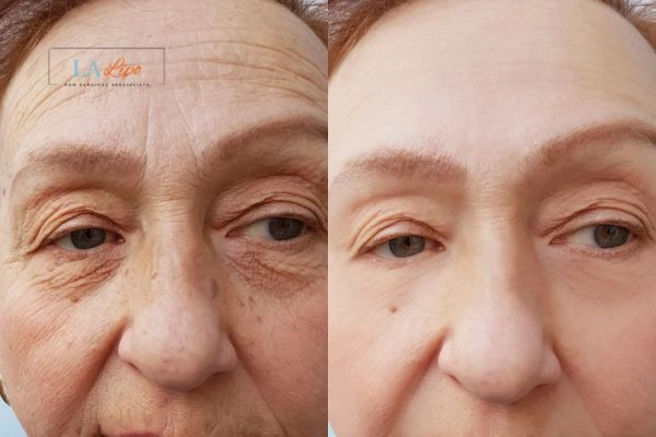 The powerful benefits of Morpheus8 Treatment Cheshunt - Call Our team today!