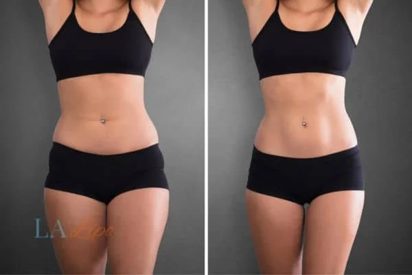 before and after results of non-surgical treatment to help a woman's body image and mental health Cheshunt