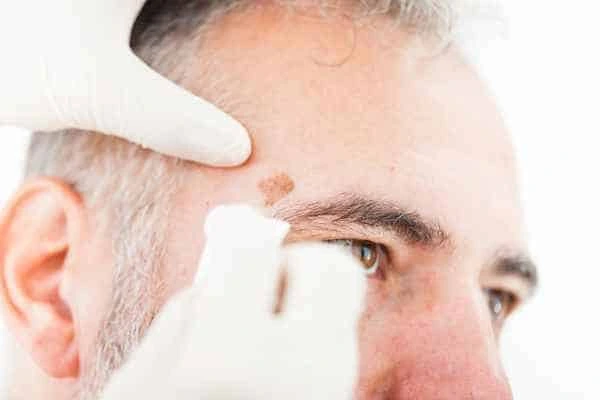 Age spots and elderly people Cheshunt what is the link?
