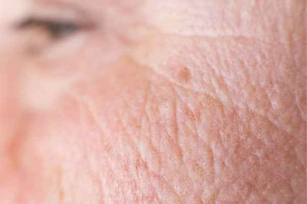 close up picture of a woman's face showing an age spot Cheshunt