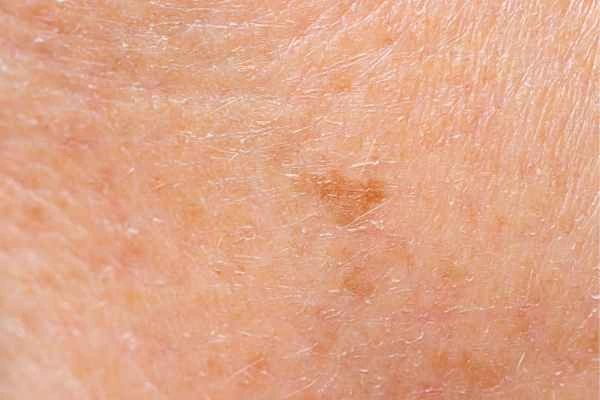 close up picture of age spots Cheshunt
