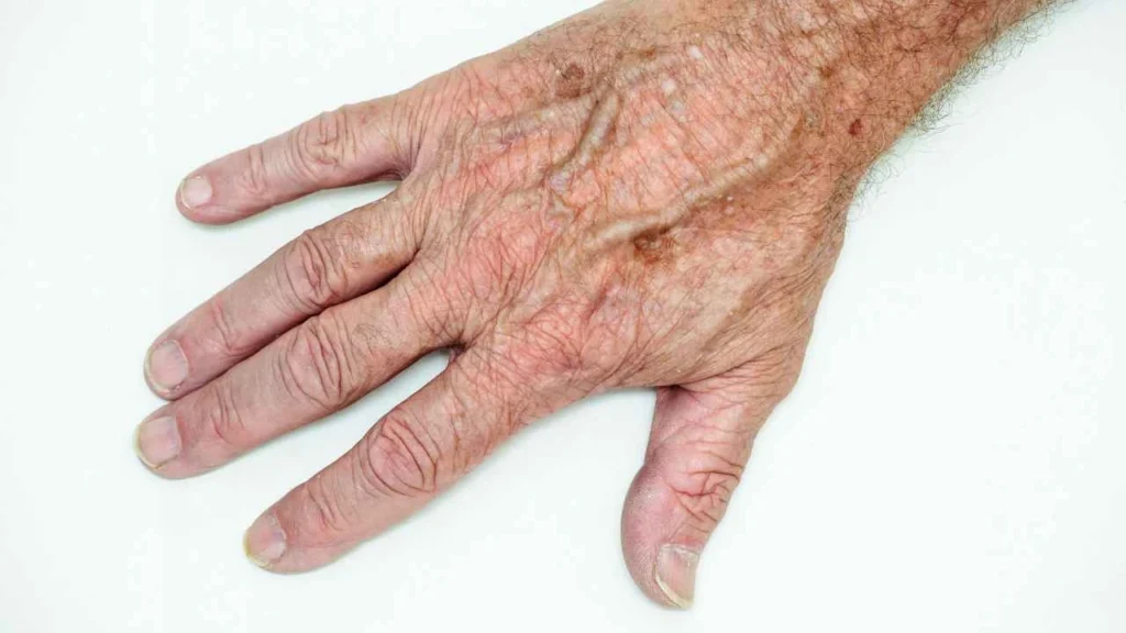 Male hand showing age spot Cheshunt