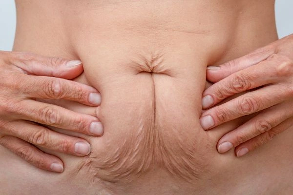 Image of a woman's stomach with loose skin - example of skin tightening Cheshunt options