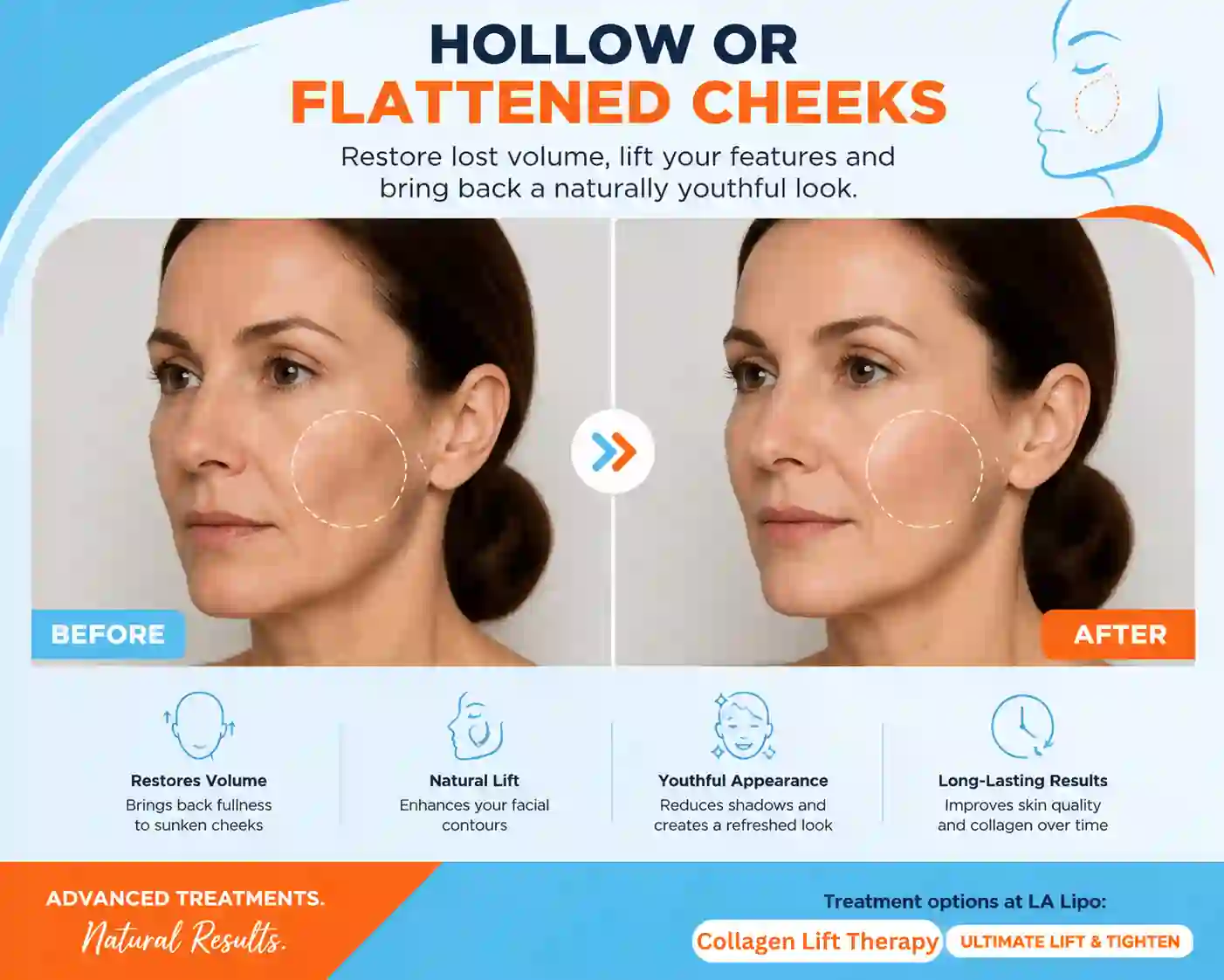 Sign #4: Hollow or Flattened Cheeks Cheshunt