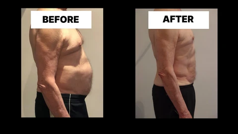 What Symptoms Can Diastasis Recti Cause in Men? Weak Core, Back Pain and Poor Posture Cheshunt